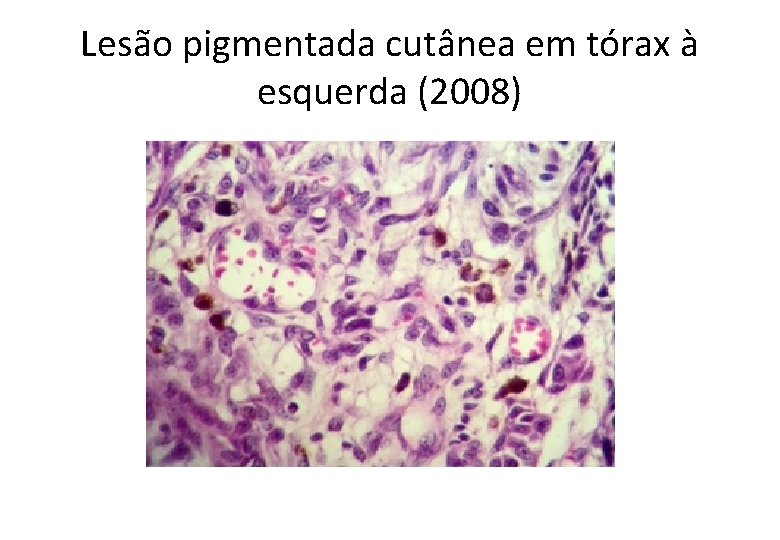 Lesão pigmentada cutânea em tórax à esquerda (2008) 