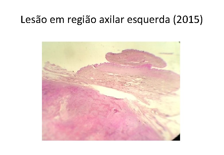 Lesão em região axilar esquerda (2015) 