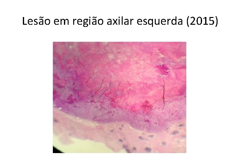 Lesão em região axilar esquerda (2015) 