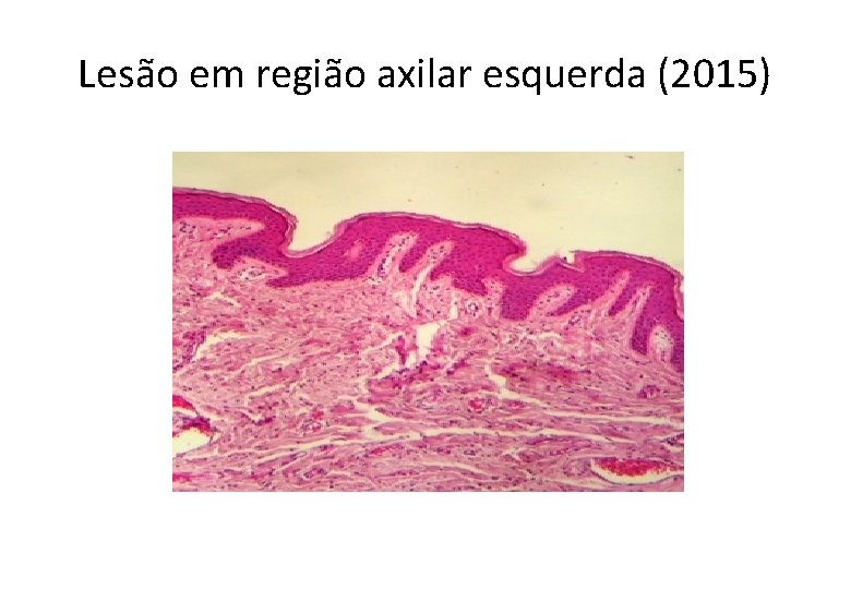 Lesão em região axilar esquerda (2015) 