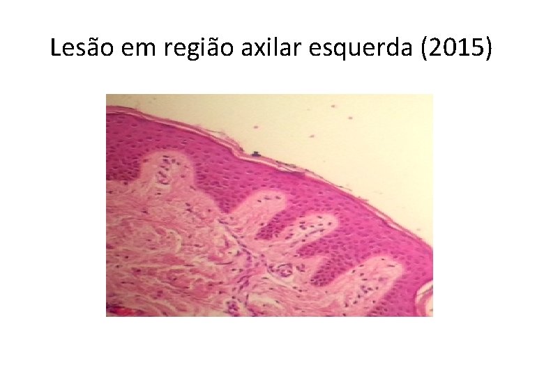 Lesão em região axilar esquerda (2015) 