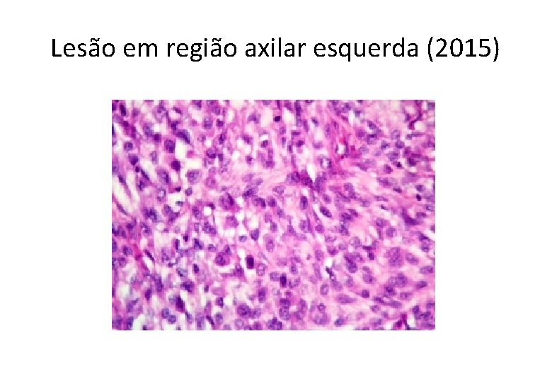 Lesão em região axilar esquerda (2015) 