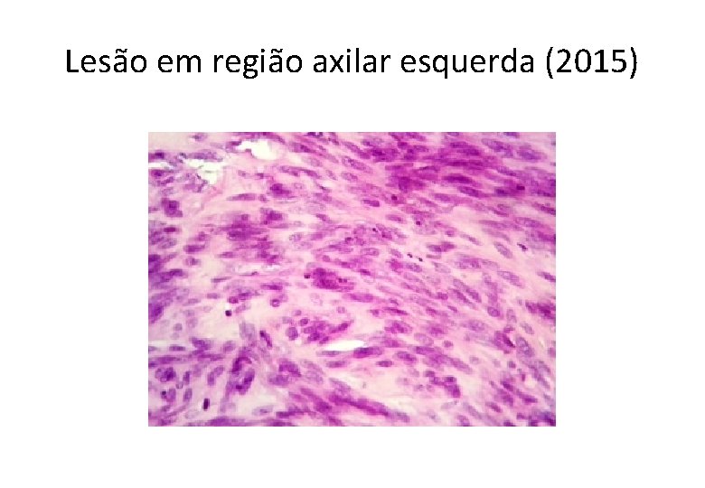 Lesão em região axilar esquerda (2015) 