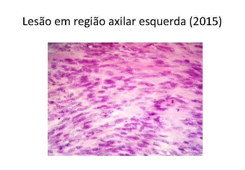 Lesão em região axilar esquerda (2015) 