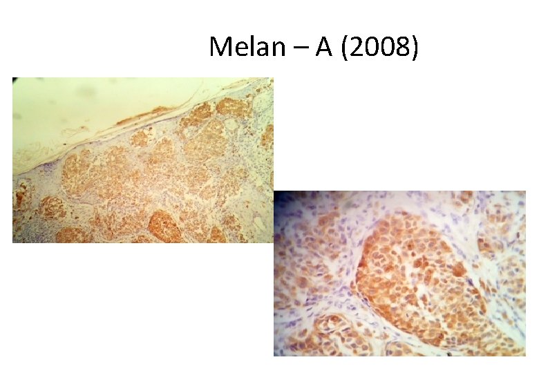  Melan – A (2008) 