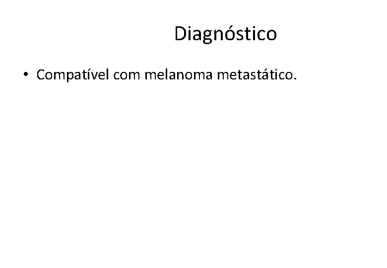  Diagnóstico • Compatível com melanoma metastático. 