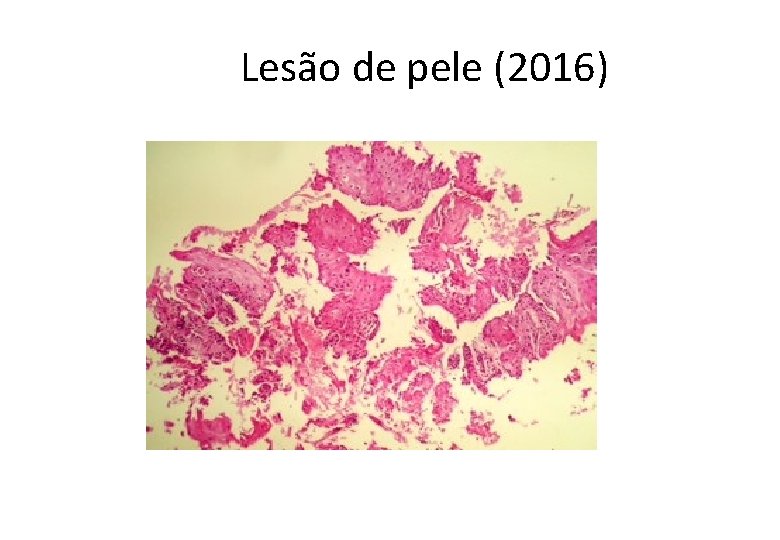  Lesão de pele (2016) 