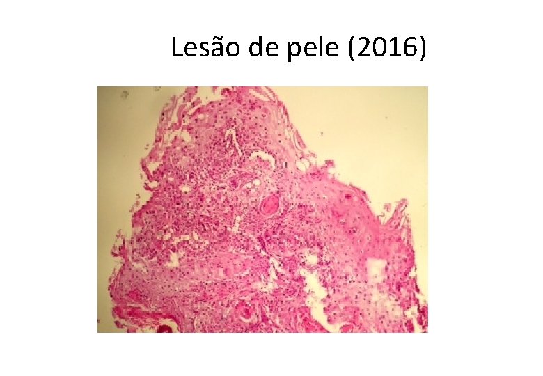  Lesão de pele (2016) 