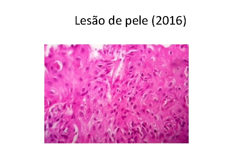  Lesão de pele (2016) 