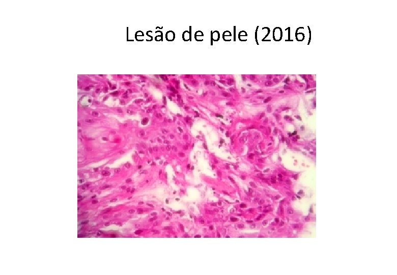  Lesão de pele (2016) 