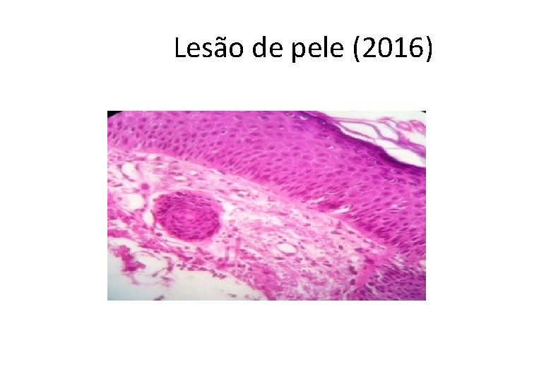  Lesão de pele (2016) 