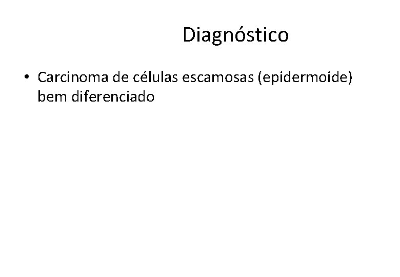  Diagnóstico • Carcinoma de células escamosas (epidermoide) bem diferenciado 