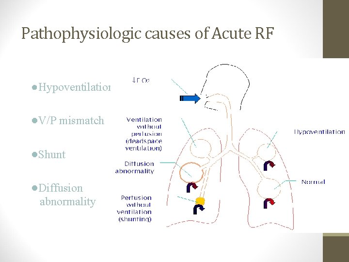 Pathophysiologic causes of Acute RF ●Hypoventilation ●V/P mismatch ●Shunt ●Diffusion abnormality 