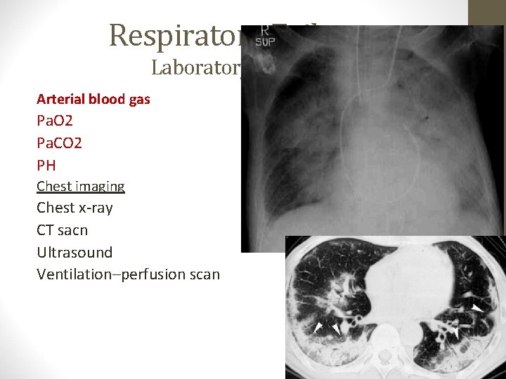 Respiratory Failure Laboratory Testing Arterial blood gas Pa. O 2 Pa. CO 2 PH