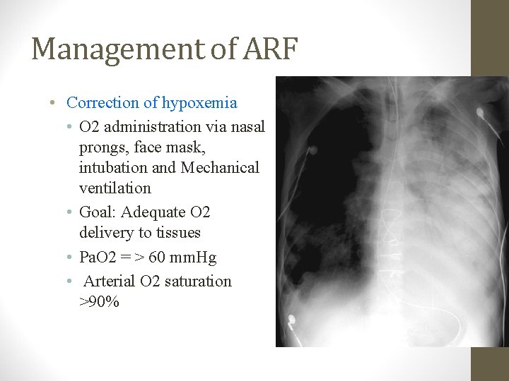 Management of ARF • Correction of hypoxemia • O 2 administration via nasal prongs,