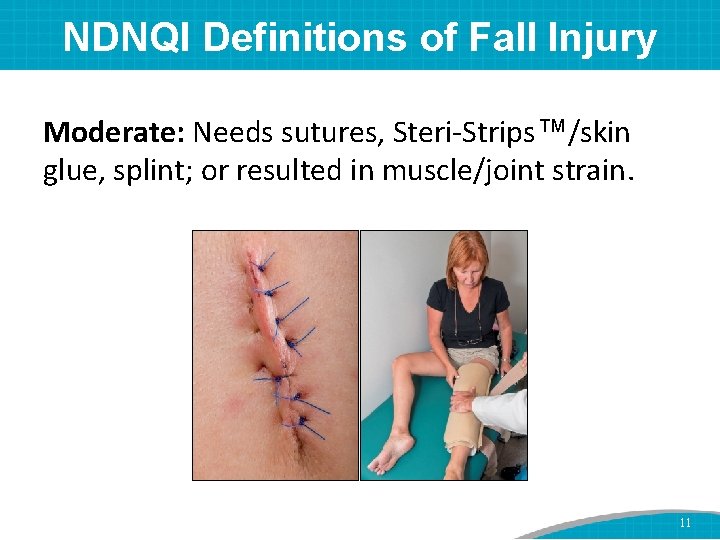 NDNQI Definitions of Fall Injury Moderate: Needs sutures, Steri-Strips™/skin glue, splint; or resulted in