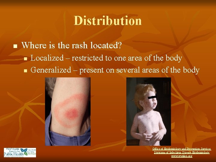 Distribution n Where is the rash located? n n Localized – restricted to one