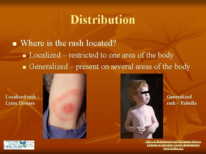 Distribution n Where is the rash located? n n Localized – restricted to one
