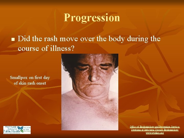 Progression n Did the rash move over the body during the course of illness?