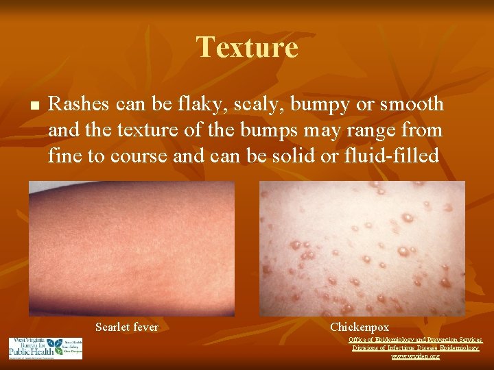 Texture n Rashes can be flaky, scaly, bumpy or smooth and the texture of