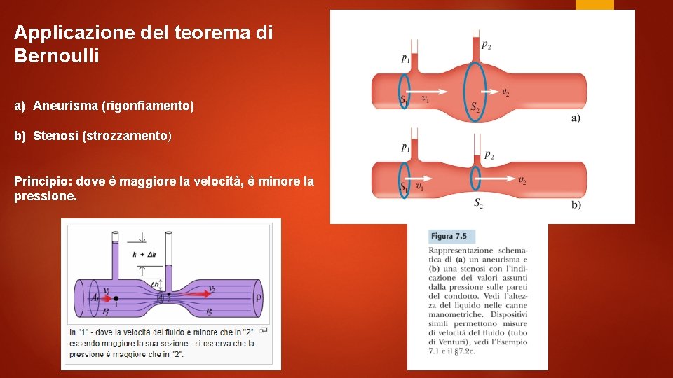 Applicazione del teorema di Bernoulli a) Aneurisma (rigonfiamento) b) Stenosi (strozzamento) Principio: dove è