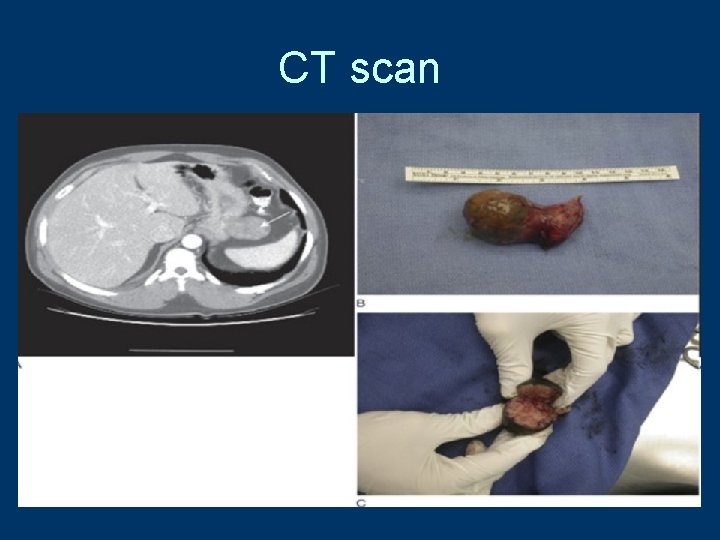 CT scan 