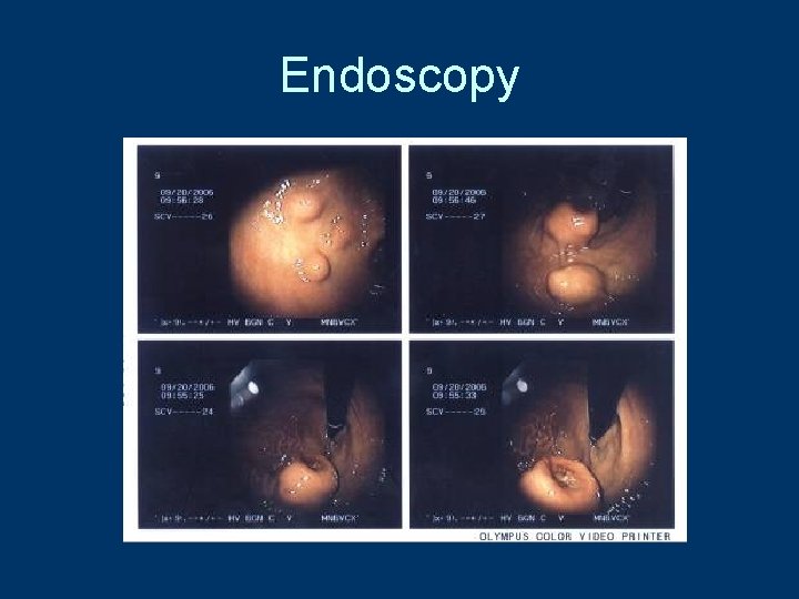 Endoscopy 