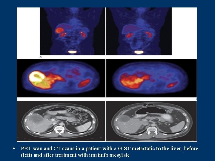  • PET scan and CT scans in a patient with a GIST metastatic