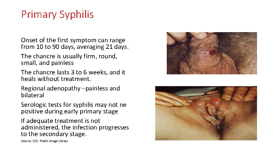 Primary Syphilis Onset of the first symptom can range from 10 to 90 days,