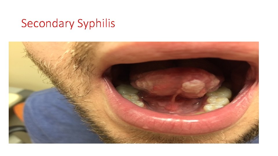 Secondary Syphilis 