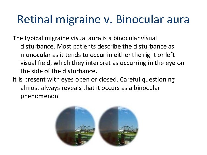 Retinal migraine v. Binocular aura The typical migraine visual aura is a binocular visual