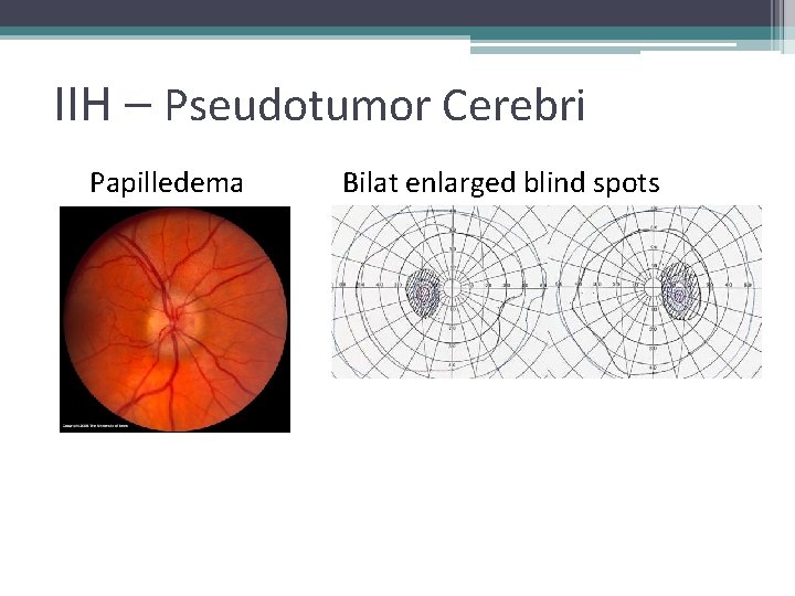 IIH – Pseudotumor Cerebri Papilledema Bilat enlarged blind spots 