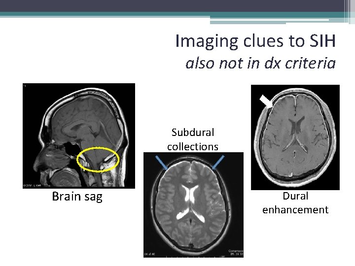 Imaging clues to SIH also not in dx criteria Subdural collections Brain sag Dural