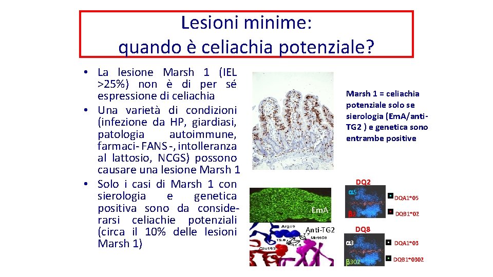 Lesioni minime: quando è celiachia potenziale? • La lesione Marsh 1 (IEL >25%) non