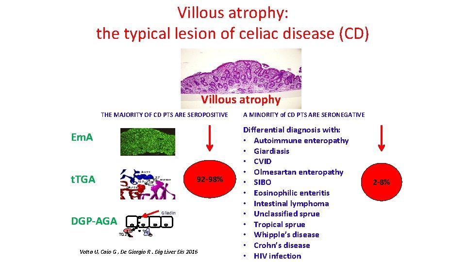Villous atrophy: the typical lesion of celiac disease (CD) Villous atrophy THE MAJORITY OF