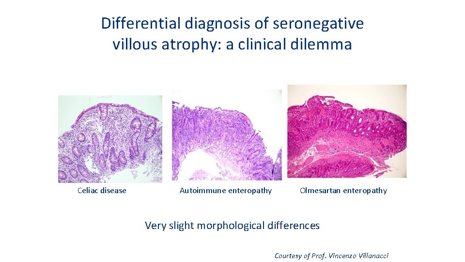 Differential diagnosis of seronegative villous atrophy: a clinical dilemma Celiac disease Autoimmune enteropathy Olmesartan