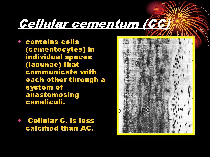 Cellular cementum (CC) • contains cells (cementocytes) in individual spaces (lacunae) that communicate with