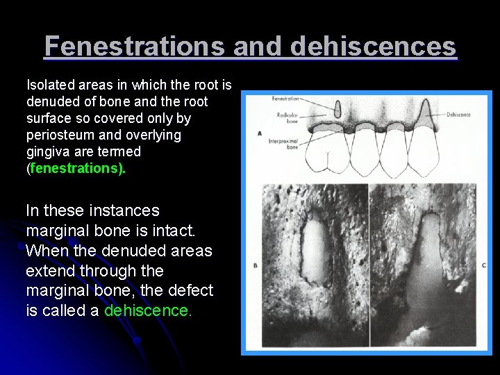 Fenestrations and dehiscences Isolated areas in which the root is denuded of bone and