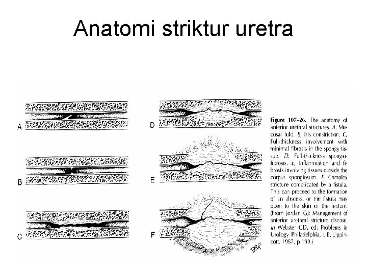 Anatomi striktur uretra 