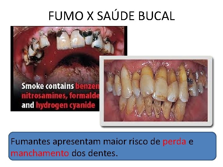 FUMO X SAÚDE BUCAL Fumantes apresentam maior risco de perda e manchamento dos dentes.