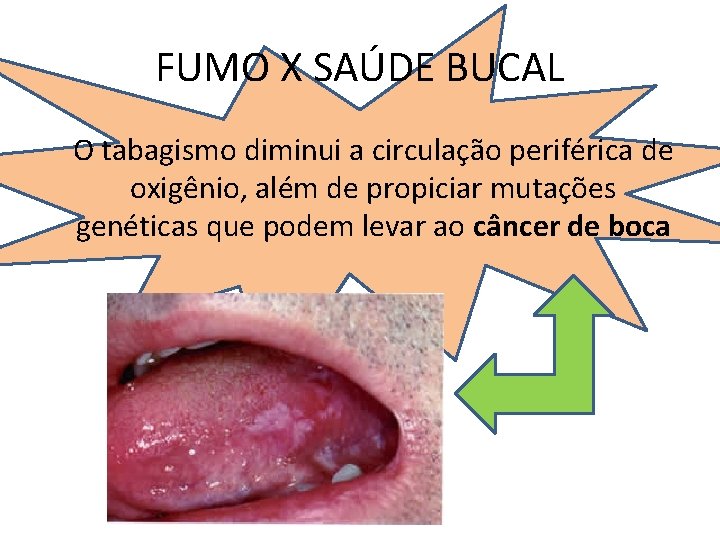 FUMO X SAÚDE BUCAL O tabagismo diminui a circulação periférica de oxigênio, além de