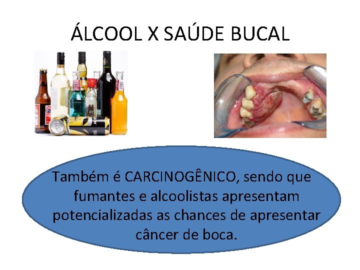 ÁLCOOL X SAÚDE BUCAL Também é CARCINOGÊNICO, sendo que fumantes e alcoolistas apresentam potencializadas