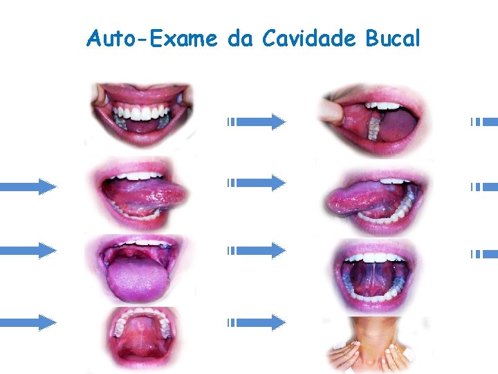 Auto-Exame da Cavidade Bucal 
