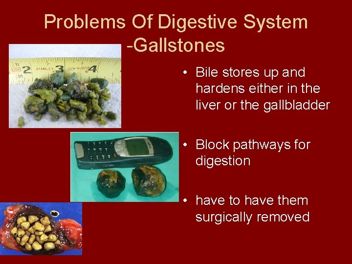 Problems Of Digestive System -Gallstones • Bile stores up and hardens either in the