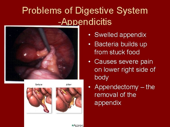 Problems of Digestive System -Appendicitis • Swelled appendix • Bacteria builds up from stuck