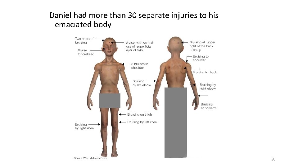 Daniel had more than 30 separate injuries to his emaciated body 30 