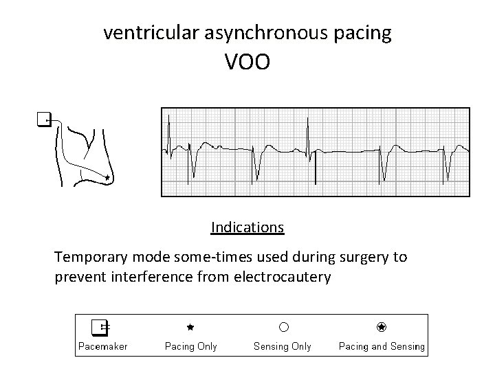 ventricular asynchronous pacing VOO Indications Temporary mode some-times used during surgery to prevent interference
