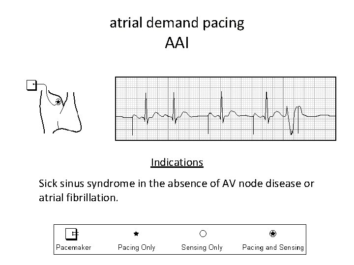 atrial demand pacing AAI Indications Sick sinus syndrome in the absence of AV node