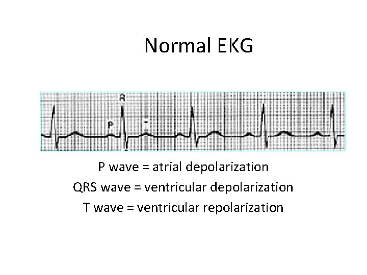 Normal EKG P wave = atrial depolarization QRS wave = ventricular depolarization T wave