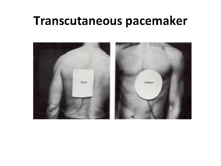 Transcutaneous pacemaker 